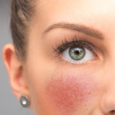Alternative view of BioRosacea Anti-Redness Gel